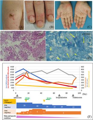 A case of anti-melanoma differentiation antigen 5 antibody-positive dermatomyositis in which monitoring of Ro52/IgG/HLA-DR complex antibody titer was useful to exclude interstitial pneumonia